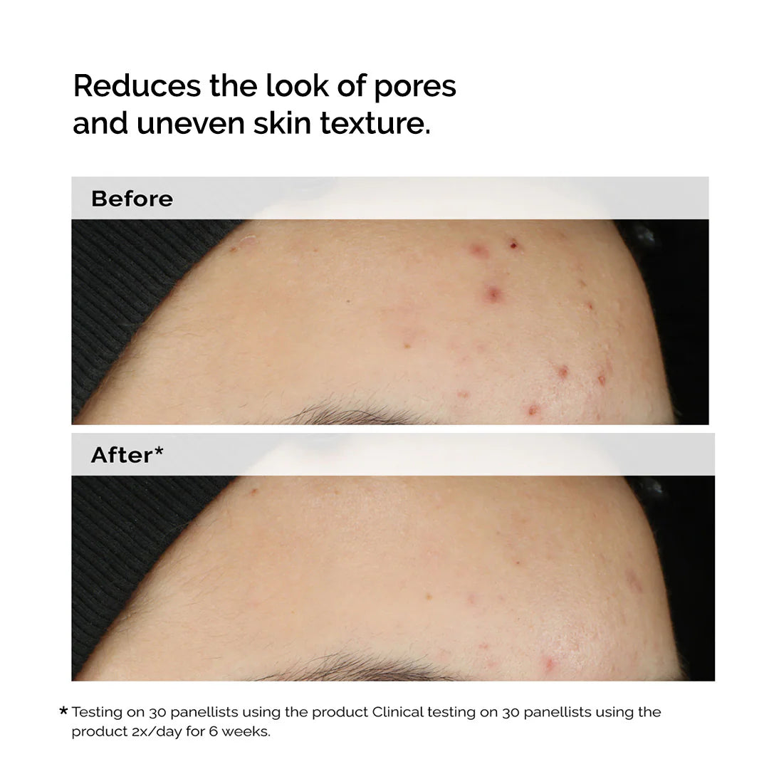 The Ordinary
Balancing & Clarifying Serum for Blemish-Prone Skin