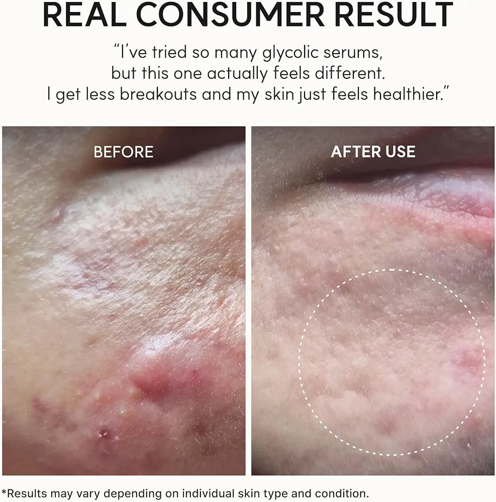 Arencia Eraser Shot Serum Glycolic Acid Booster with AHA BHA, Exfoliating Face Serum