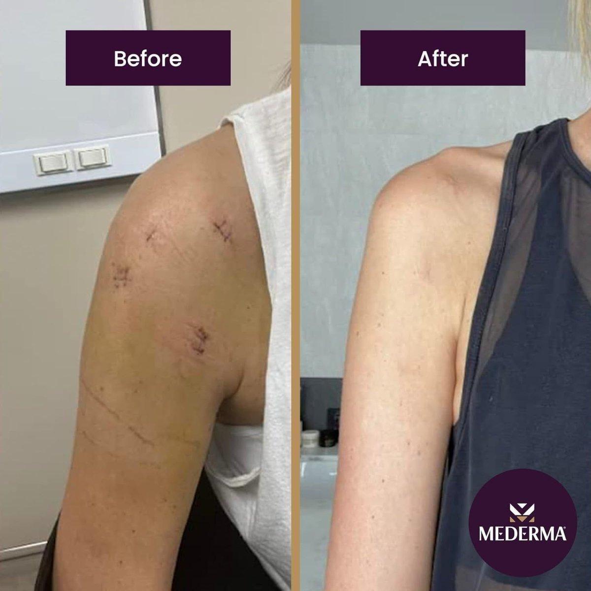 Mederma Advanced Scar Gel 50GM